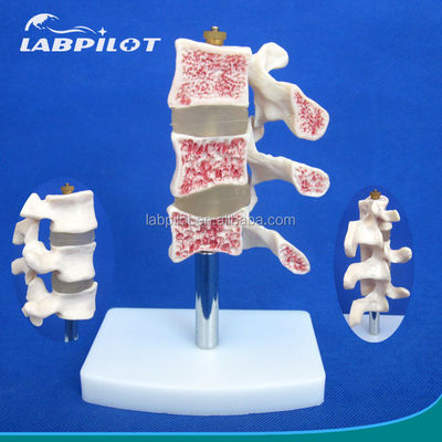 Erweiterte PVC-Bildungsmodelle Abtrennung Osteoporose der Wirbelsäule Läsionen des Lendenwirbels