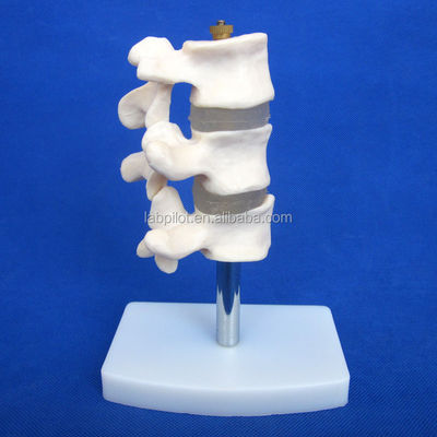 Erweiterte PVC-Bildungsmodelle Abtrennung Osteoporose der Wirbelsäule Läsionen des Lendenwirbels
