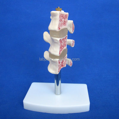 Erweiterte PVC-Bildungsmodelle Abtrennung Osteoporose der Wirbelsäule Läsionen des Lendenwirbels