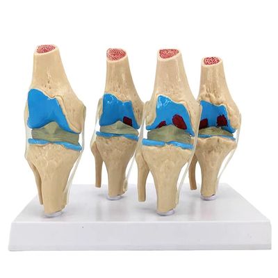Anatomische Demonstration des menschlichen Knie-Gelenkpathologie-Modells für die Medizinische Wissenschaft