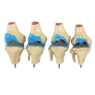 Anatomische Demonstration des menschlichen Knie-Gelenkpathologie-Modells für die Medizinische Wissenschaft