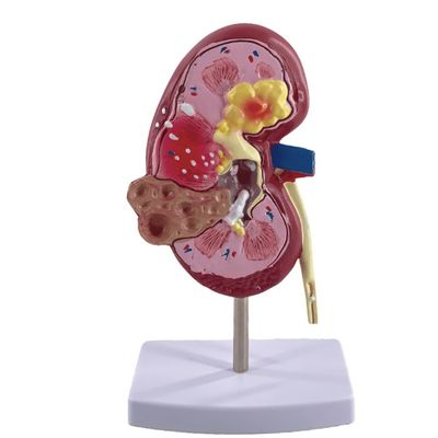 PVC-Pathologische Nierenmodell für Medizinische Fakultäten und Urologische Krankenhäuser Demonstration