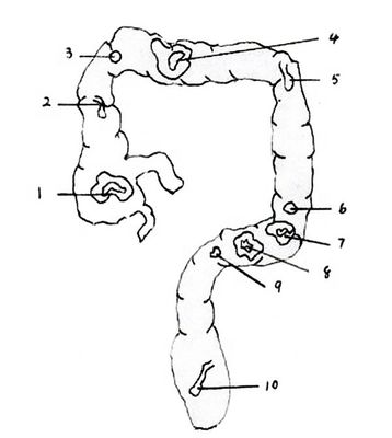 Anatomie Modell von Rektum und Dickdarm Advanced PVC Human Life Size Darm Endoskopie Simulator